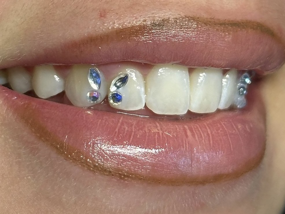 Glimlach met twee blauwe tooth gems op de voortanden