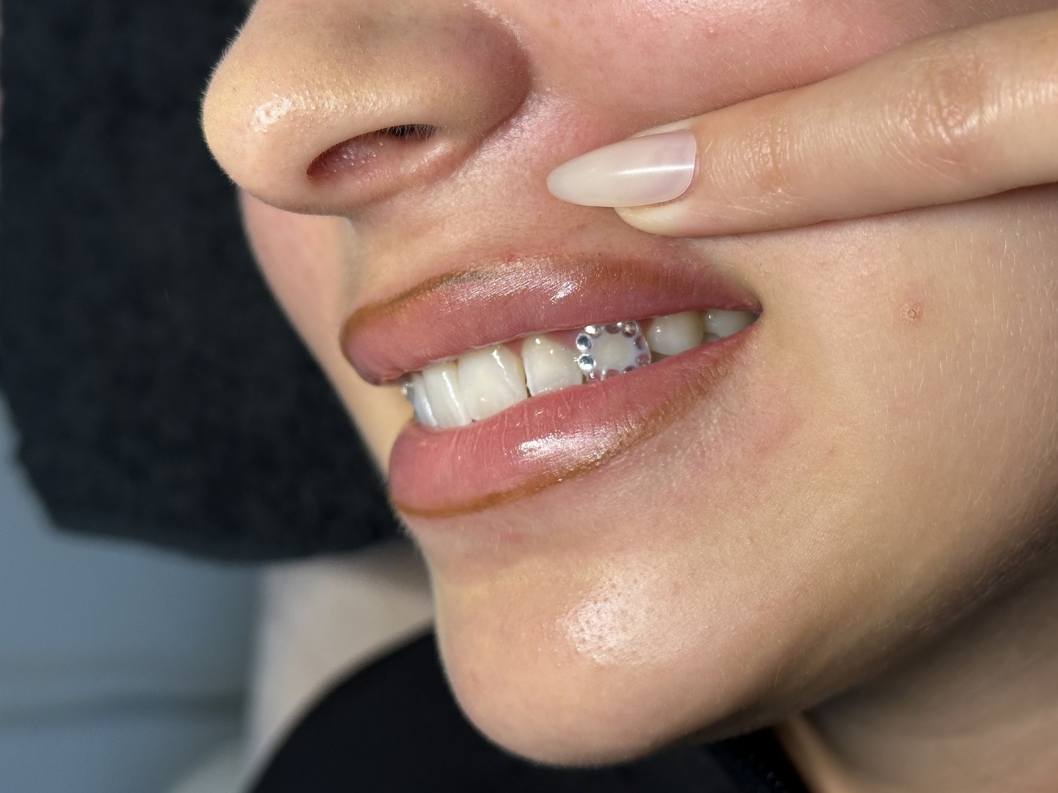 Tooth gems, zichtbaar bij een opgetrokken lip
